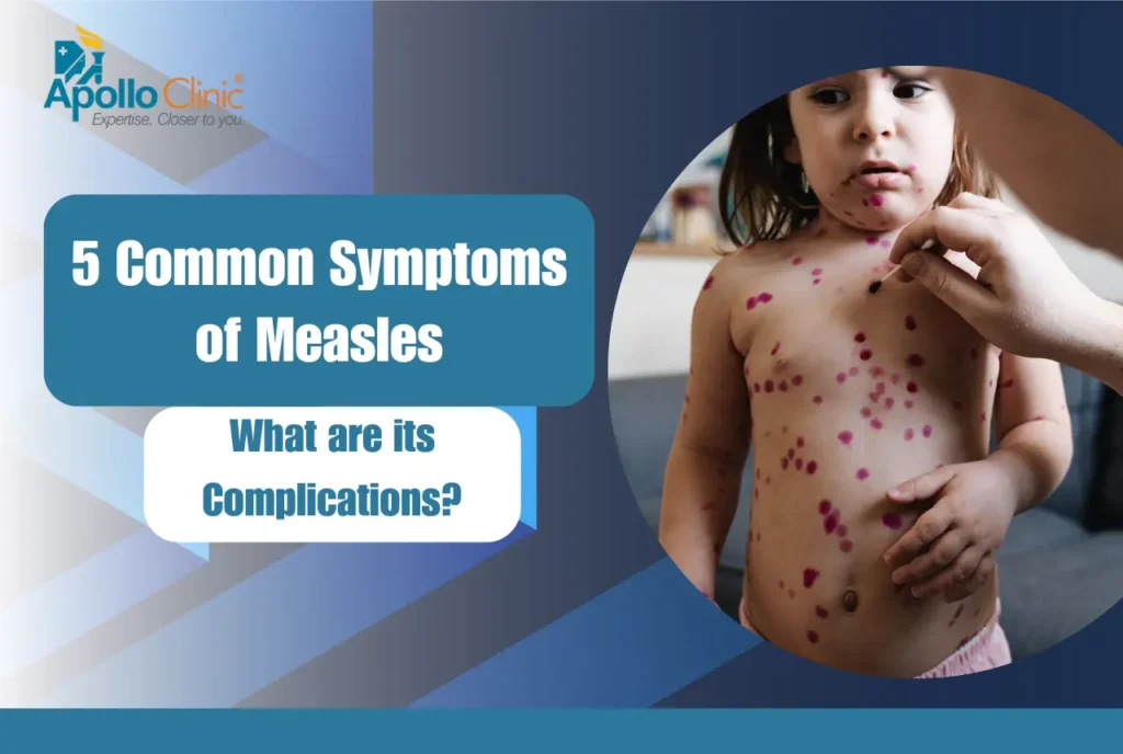 symptoms of measles